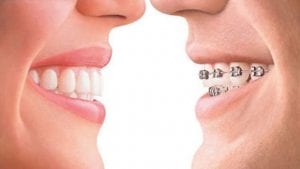 Invisalign Braces vs Metal Fixed Braces