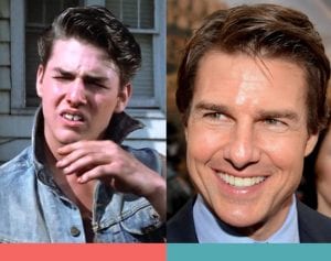 Braces Invisalign Before and After Tom Cruise