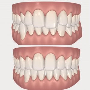 Invisalign ClinCheck Before After