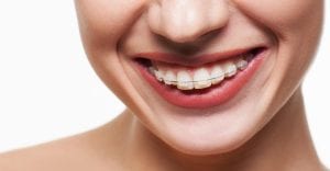 fixed ceramic braces wolverhampton