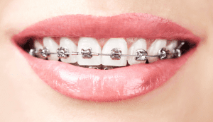 fixed metal braces wolverhampton