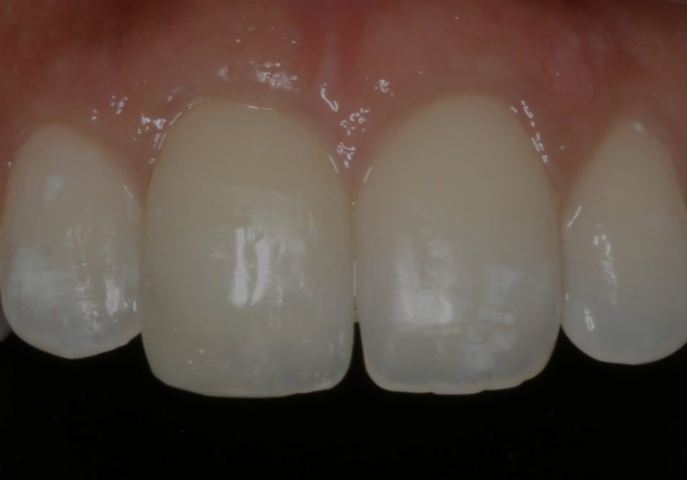 Composite Bonding Wolverhampton