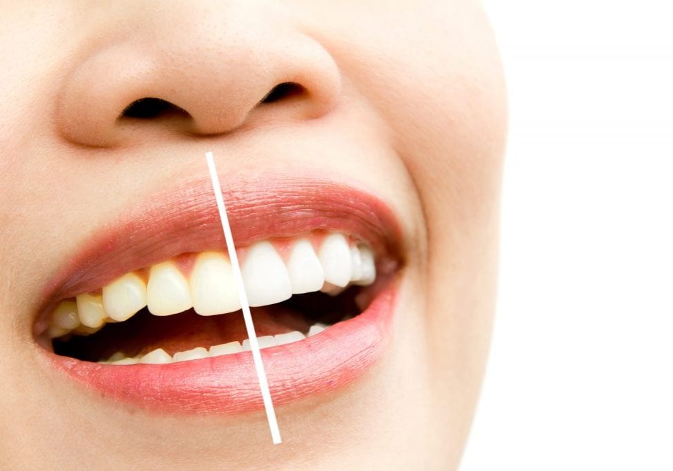 Is teeth whitening safe. Before and after. Rock Dental Wolverhampton Dentist
